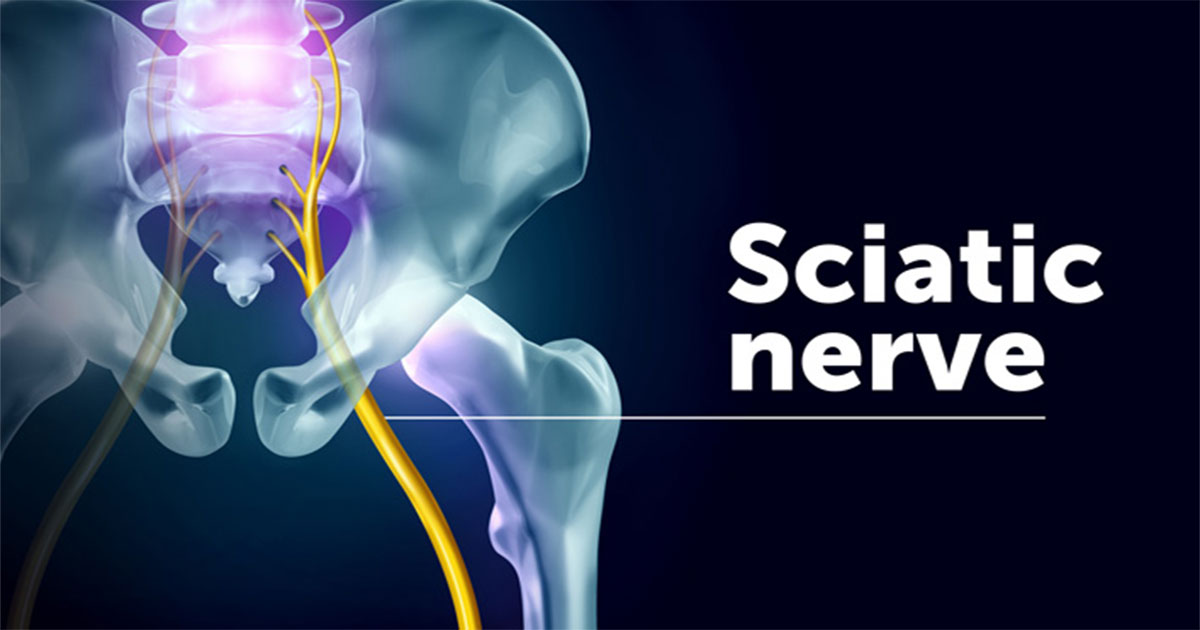 Sciatic pain - everything you need to know